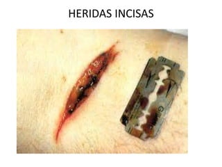 HERIDAS INCISAS
 