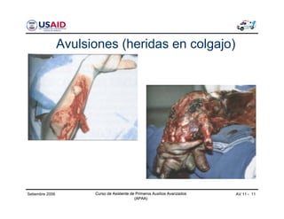 Curso de Asistente de Primeros Auxilios Avanzados
(APAA)
AV 11 - 11Curso de Asistente de Primeros Auxilios Avanzados
(APAA)
Setiembre 2006 Curso de Asistente de Primeros Auxilios Avanzados
(APAA)
Avulsiones (heridas en colgajo)
 