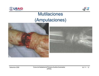 Curso de Asistente de Primeros Auxilios Avanzados
(APAA)
AV 11 - 12Curso de Asistente de Primeros Auxilios Avanzados
(APAA)
Setiembre 2006 Curso de Asistente de Primeros Auxilios Avanzados
(APAA)
Mutilaciones
(Amputaciones)
 