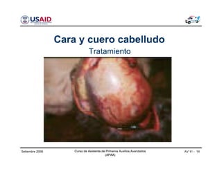 Curso de Asistente de Primeros Auxilios Avanzados
(APAA)
AV 11 - 14Curso de Asistente de Primeros Auxilios Avanzados
(APAA)
Setiembre 2006 Curso de Asistente de Primeros Auxilios Avanzados
(APAA)
Cara y cuero cabelludo
Tratamiento
 