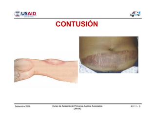 Curso de Asistente de Primeros Auxilios Avanzados
(APAA)
AV 11 - 5Curso de Asistente de Primeros Auxilios Avanzados
(APAA)
Setiembre 2006 Curso de Asistente de Primeros Auxilios Avanzados
(APAA)
CONTUSIÓN
 