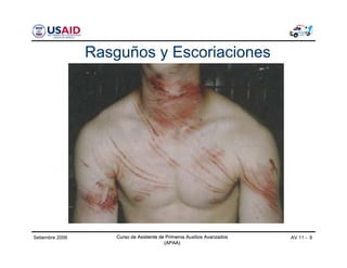 Curso de Asistente de Primeros Auxilios Avanzados
(APAA)
AV 11 - 8Curso de Asistente de Primeros Auxilios Avanzados
(APAA)
Setiembre 2006 Curso de Asistente de Primeros Auxilios Avanzados
(APAA)
Rasguños y Escoriaciones
 