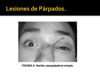 Lesiones de Párpados.