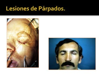 Lesiones de Párpados.