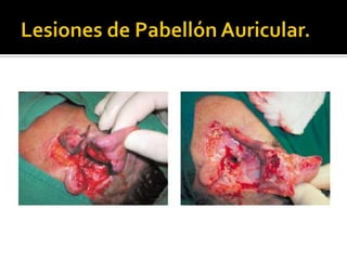 Lesiones de Pabellón Auricular.