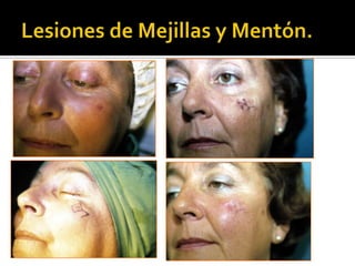 Lesiones de Mejillas y Mentón.