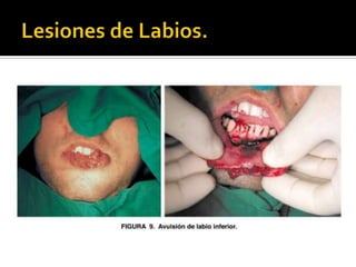 Lesiones de Labios.