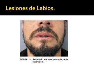 Lesiones de Labios.