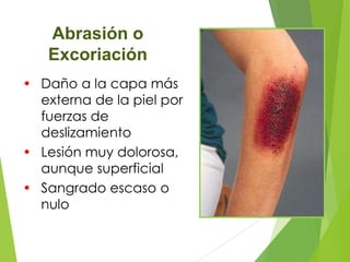 Abrasión o
Excoriación
• Daño a la capa más
externa de la piel por
fuerzas de
deslizamiento
• Lesión muy dolorosa,
aunque superficial
• Sangrado escaso o
nulo

 