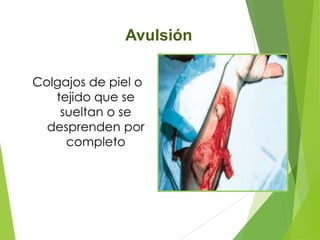 Avulsión
Colgajos de piel o
tejido que se
sueltan o se
desprenden por
completo

 