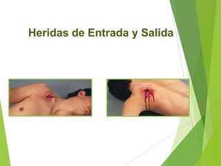 Heridas de Entrada y Salida

 