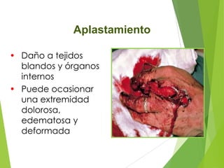 Aplastamiento
• Daño a tejidos
blandos y órganos
internos
• Puede ocasionar
una extremidad
dolorosa,
edematosa y
deformada

 
