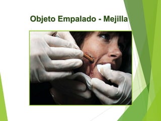 Objeto Empalado - Mejilla

 
