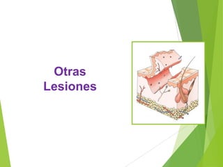 Otras
Lesiones

 