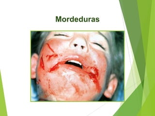 Mordeduras

 
