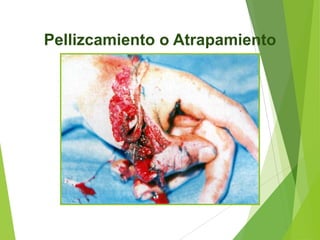 Pellizcamiento o Atrapamiento

 