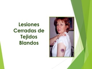 Lesiones
Cerradas de
Tejidos
Blandos

 