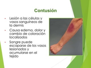 Contusión
•

•

•

Lesión a las células y
vasos sanguíneos de
la dermis
Causa edema, dolor y
cambio de coloración
localizados
Sangre puede
escaparse de los vasos
lesionados y
acumularse en el
tejido

 