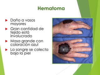 Hematoma
Daño a vasos
mayores
 Gran cantidad de
tejido está
involucrado
 Masa grande con
coloración azul
 La sangre se colecta
bajo la piel


 