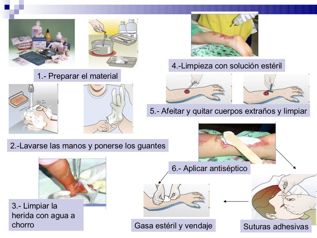 Ave Herida Primeros Auxilios Las Correctas Maniobras vrogue.co