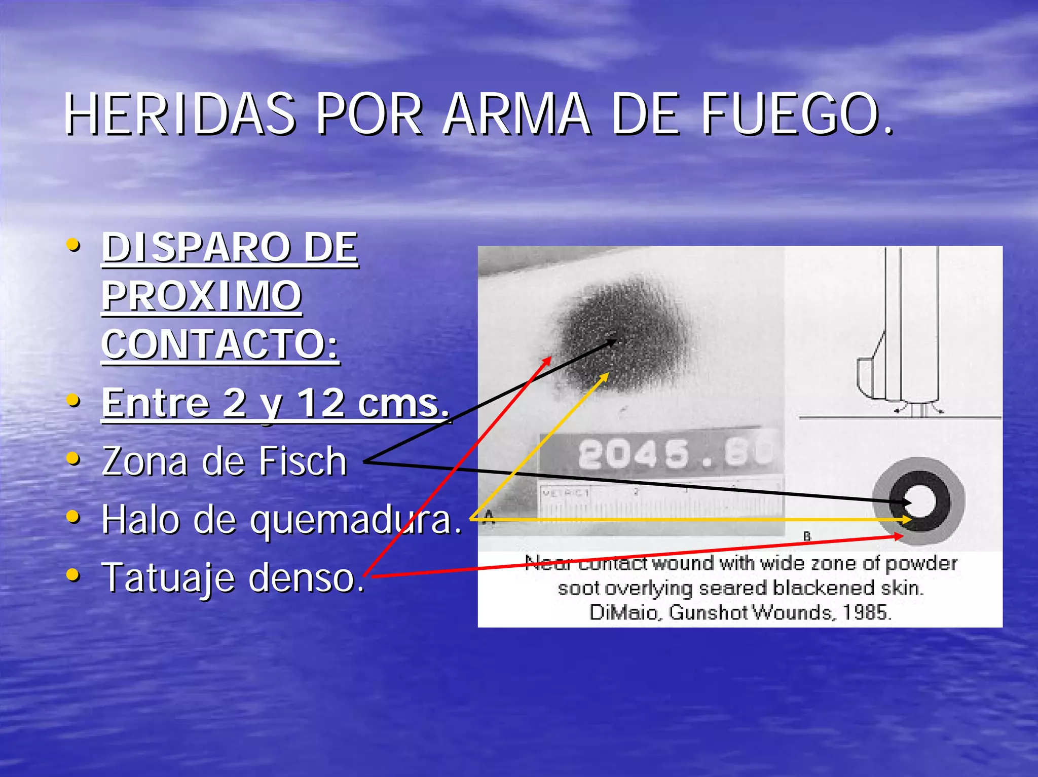 Heridas por arma de fuego | PDF