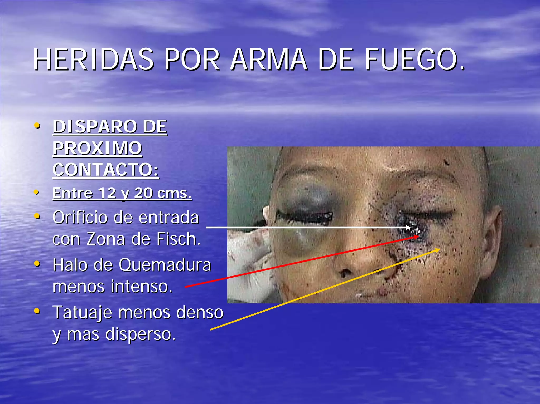 Heridas por arma de fuego | PDF