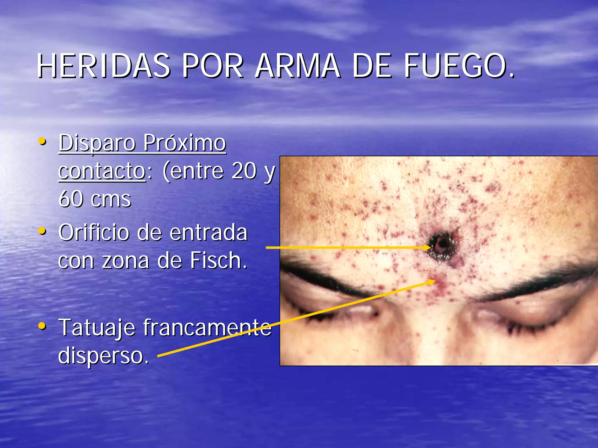Heridas por arma de fuego | PDF