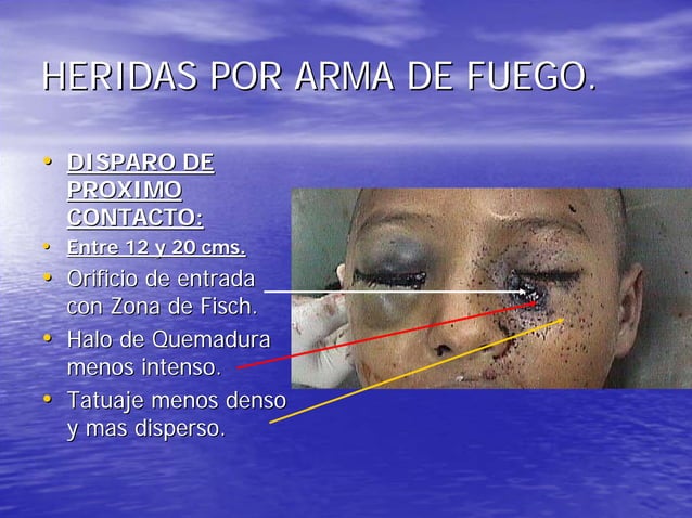 Heridas por arma de fuego | PDF