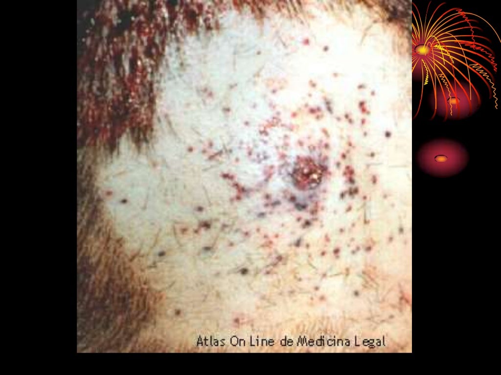 Heridas por arma de fuego Heridas por arma de fuego