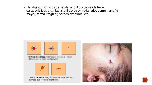 Heridas por arma de fuego Medicina Legal