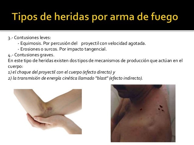 Tipos De Heridas Por Arma De Fuego www.slideshare.net