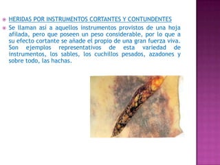 HERIDAS POR INSTRUMENTOS CORTANTES Y CONTUNDENTESSe llaman así a aquellos instrumentos provistos de una hoja afilada, pero que poseen un peso considerable, por lo que a su efecto cortante se añade el propio de una gran fuerza viva. Son ejemplos representativos de esta variedad de instrumentos, los sables, los cuchillos pesados, azadones y sobre todo, las hachas.