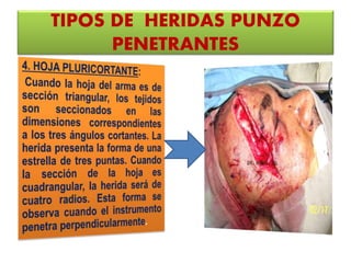 TIPOS DE HERIDAS PUNZO
PENETRANTES
 