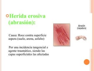 Herida erosiva (abrasión): Causa:   Roce contra superficie aspera (suelo, arena, asfalto) Por una incidencia tangencial al agente traumático, siendo las capas superficiales las afectadas 