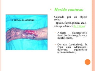 Herida contusa:   Causado por un objeto romo  (plato, fierro, piedra, etc.)  estas pueden ser  de 2 tipos : Abierta (laceración): tiene bordes irregulares y mortificados.  Cerrada (contusión): la zona está edematosa, dolorosa, equimótica (con moretones) H. CONTUSA EN ANTEBRAZO 