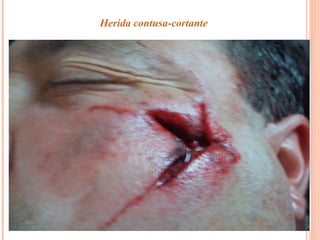 Herida contusa-cortante 