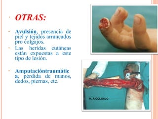 OTRAS: Avulsión , presencia de piel y tejidos arrancados pro colgajos.  Las heridas cutáneas están expuestas a este tipo de lesión. Amputacióntraumática , pérdida de manos, dedos, piernas, etc. H. A COLGAJO 