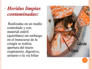 Heridas limpias contaminadas: Realizadas en un medio controlado y con material estéril (quirófano) sin embargo en el transcurso de la cirugía se realiza apertura del tracto respiratorio, digestivo, urinario o la vía biliar 