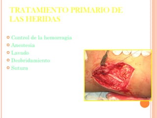 TRATAMIENTO PRIMARIO DE LAS HERIDAS Control de la hemorragia Anestesia Lavado Desbridamiento Sutura 
