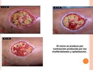El cierre se produce por contracción producida por los miofibroblastos y epitelización.  