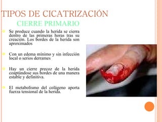 TIPOS DE CICATRIZACIÓN Se produce cuando la herida se cierra dentro de las primeras horas tras su creación. Los bordes de la herida son aproximados  Con un edema mínimo y sin infección local o serios derrames Hay un cierre precoz de la herida coaptándose sus bordes de una manera estable y definitiva.  El metabolismo del colágeno aporta fuerza tensional de la herida.  CIERRE PRIMARIO 