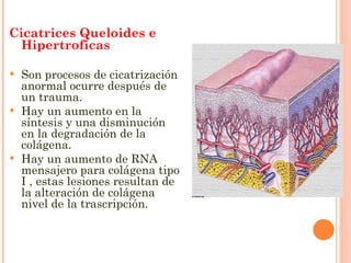 Cicatrices Queloides e Hipertroficas Son procesos de cicatrización anormal ocurre después de un trauma. Hay un aumento en la síntesis y una disminución en la degradación de la colágena. Hay un aumento de RNA mensajero para colágena tipo I , estas lesiones resultan de la alteración de colágena  nivel de la trascripción. 