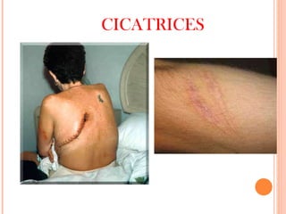 CICATRICES 