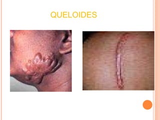 QUELOIDES 