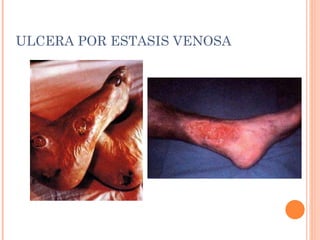ULCERA POR ESTASIS VENOSA 