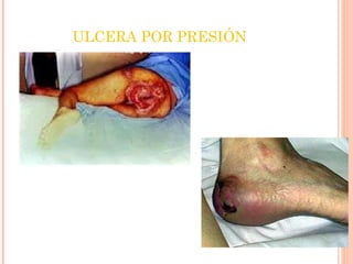 ULCERA POR PRESIÓN 