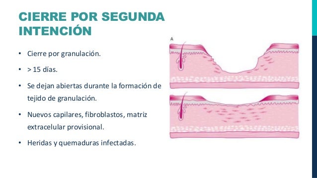 Cierre Herida Quirurgica Por Segunda Intencion