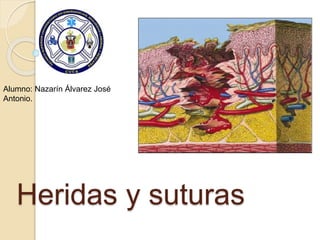 Heridas y suturas
Alumno: Nazarín Álvarez José
Antonio.
 