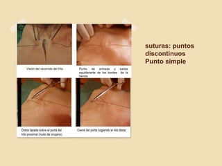 suturas: puntos
discontinuos
Punto simple
 