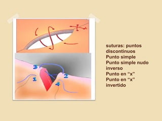 suturas: puntos
discontinuos
Punto simple
Punto simple nudo
inverso
Punto en “x”
Punto en “x”
invertido
 